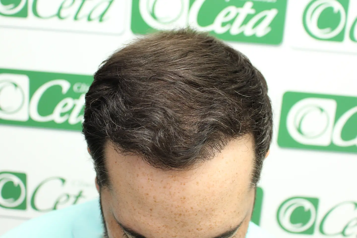 ejemplos de hombres con injerto capilar clinica ceta