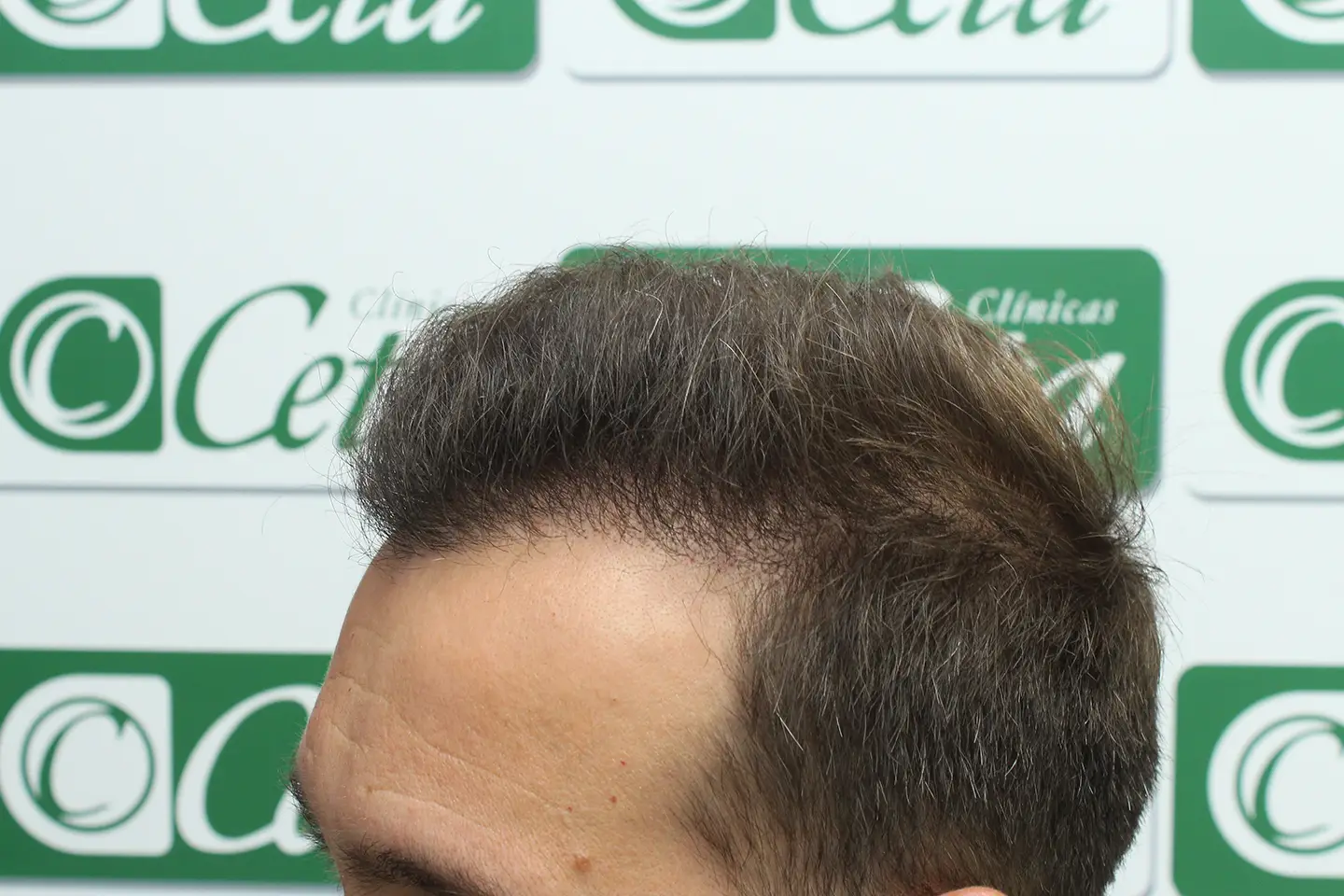 ejemplos de hombres con injerto capilar clinica ceta