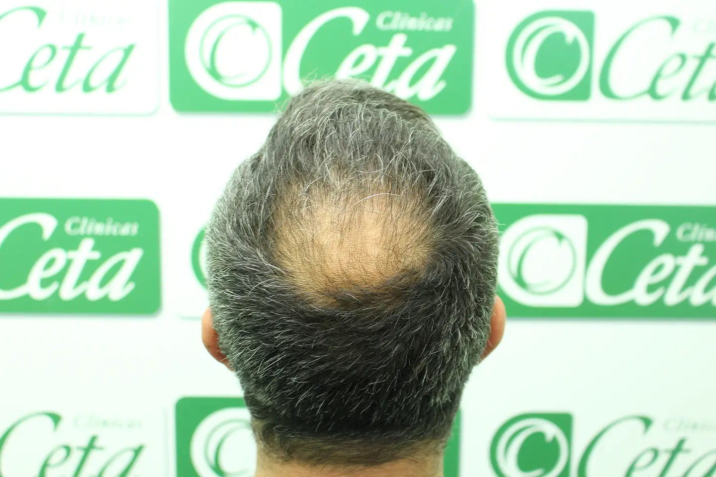 ejemplos de hombres con injerto capilar clinica ceta