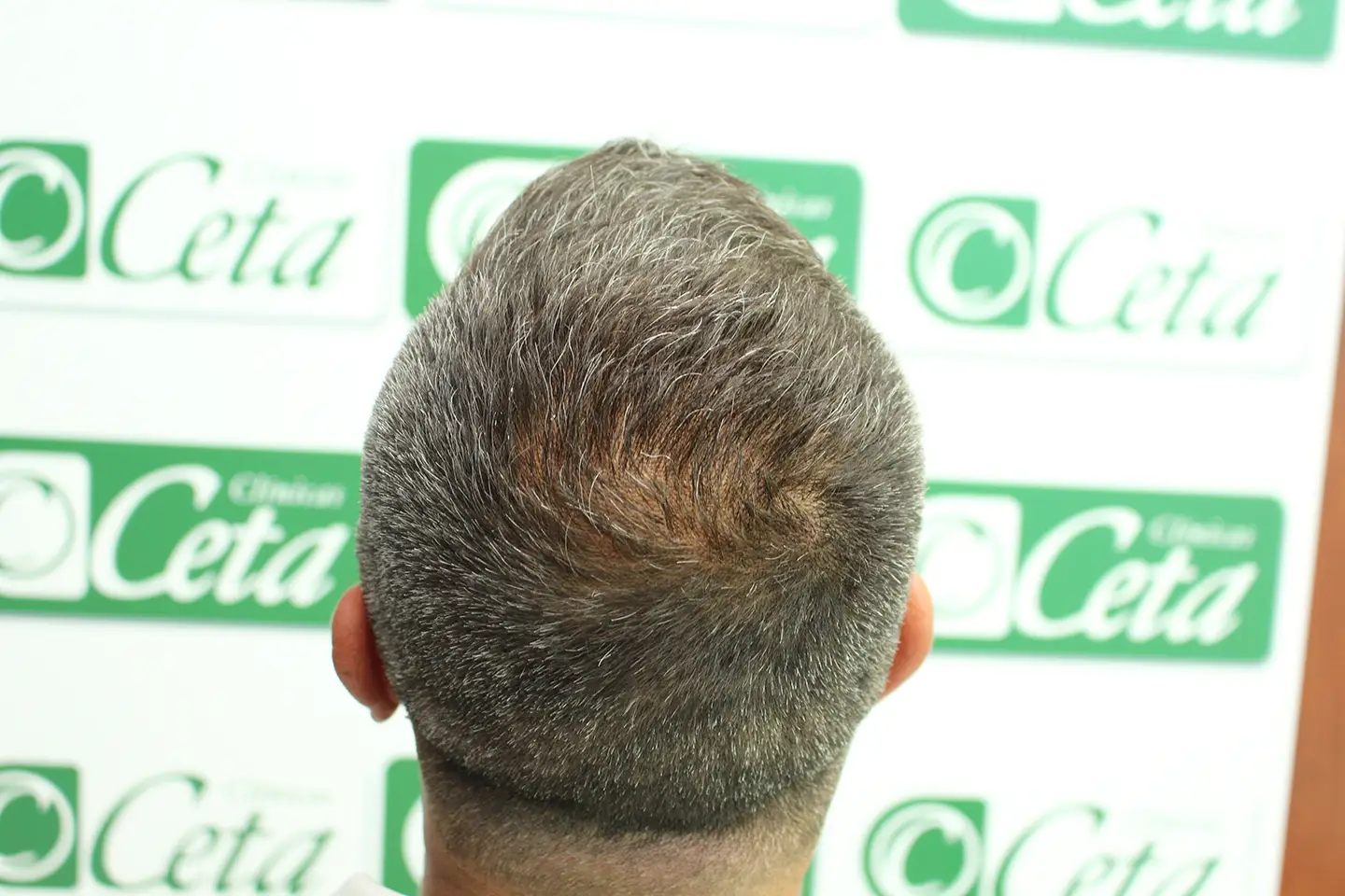 ejemplos de hombres con injerto capilar clinica ceta