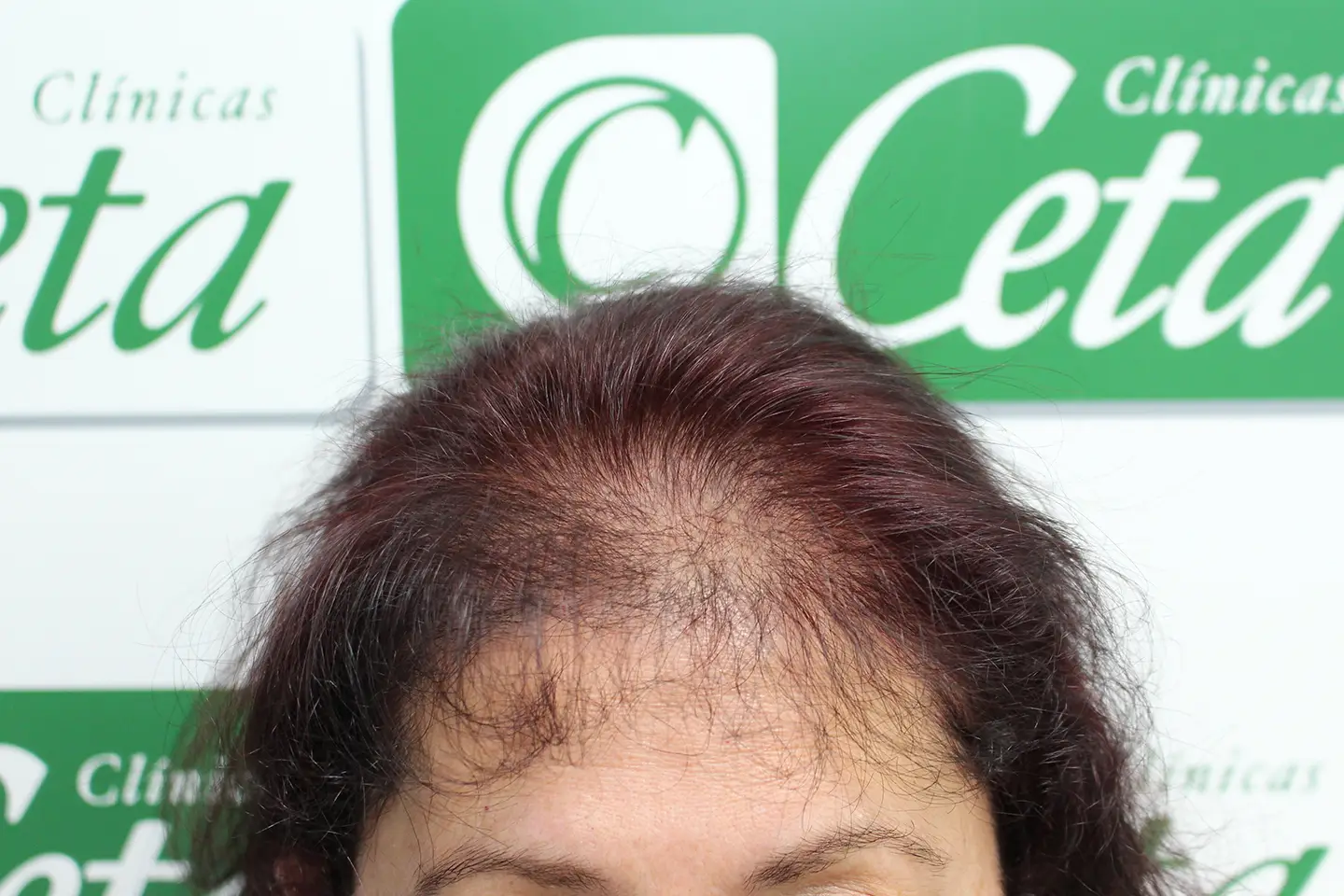 ejemplos de mujeres con injerto capilar