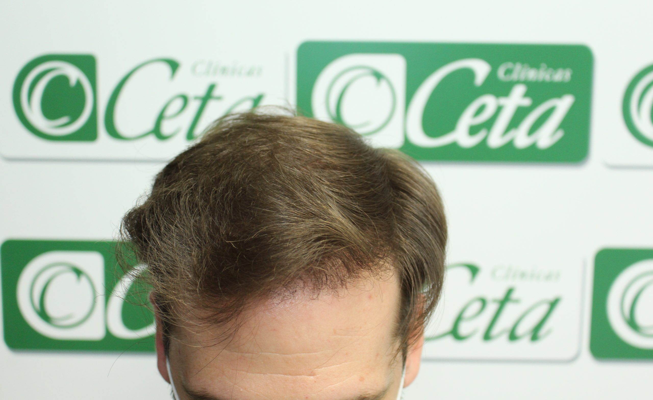 ejemplos de hombres con injerto capilar clinica ceta