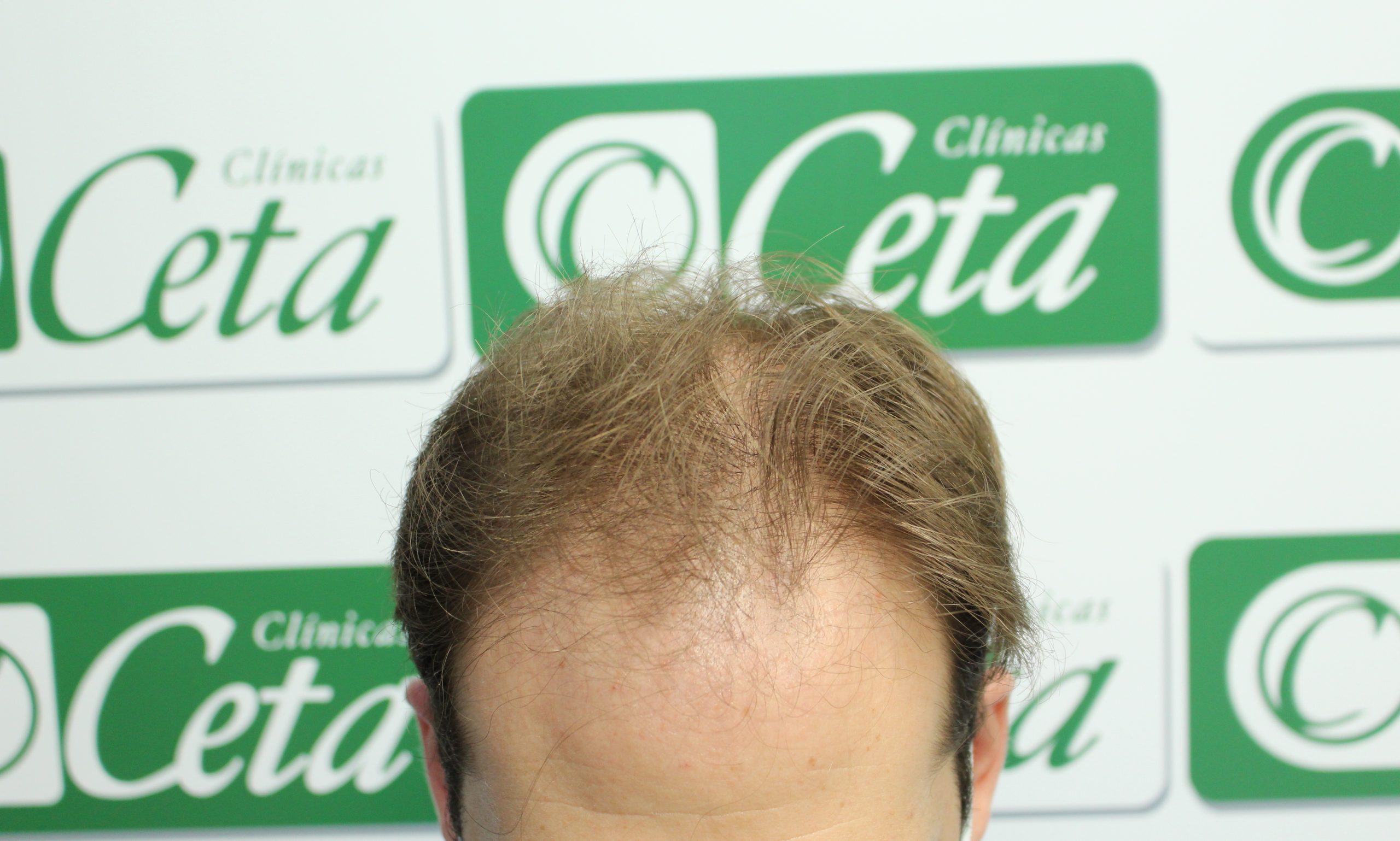 ejemplos de hombres con injerto capilar clinica ceta