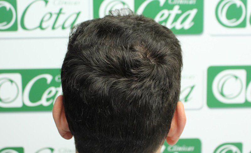 ejemplos de hombres con injerto capilar clinica ceta