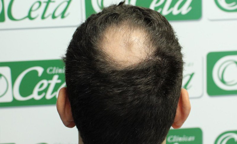 ejemplos de hombres con injerto capilar clinica ceta