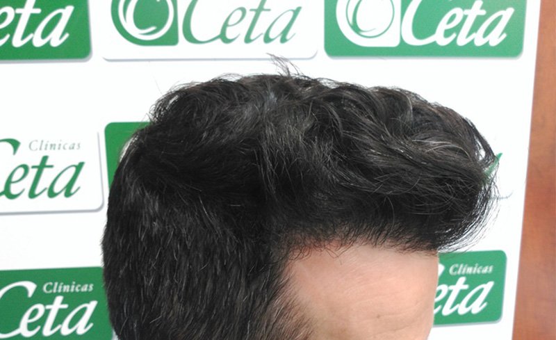 ejemplos de hombres con injerto capilar clinica ceta
