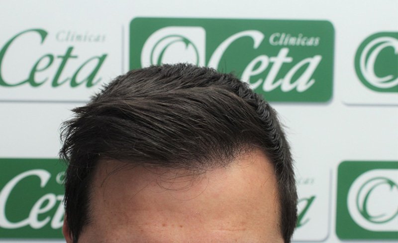ejemplos de hombres con injerto capilar clinica ceta