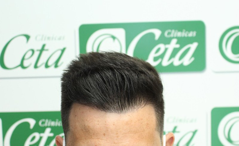 ejemplos de hombres con injerto capilar clinica ceta