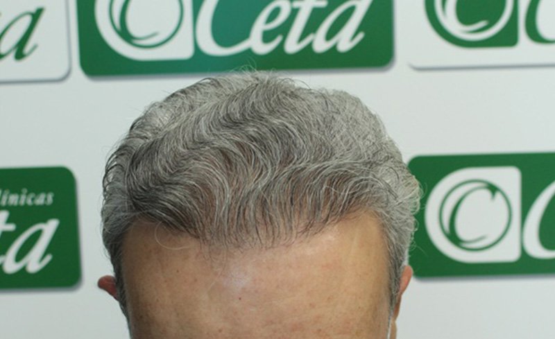 ejemplos de hombres con injerto capilar clinica ceta