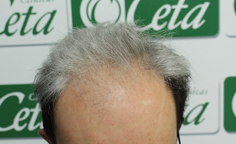 ejemplos de hombres con injerto capilar clinica ceta