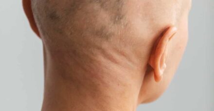 tipos alopecia areata