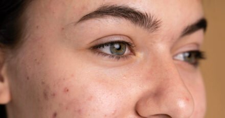 laser fraccionado acne leganes