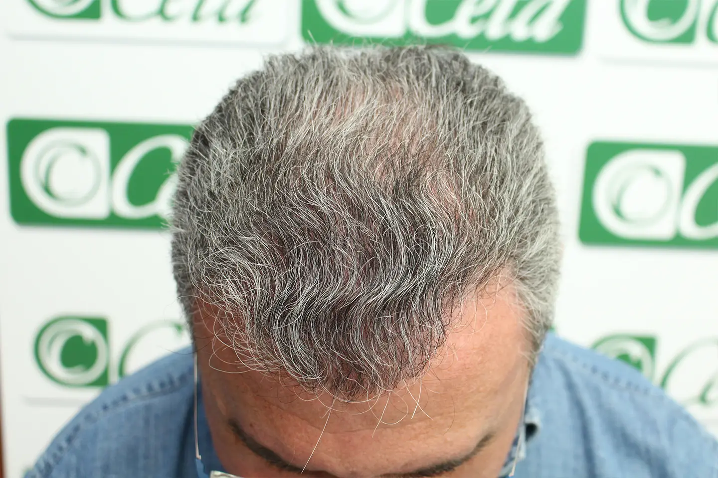 250401_injerto_capilar_caso_02_despues
