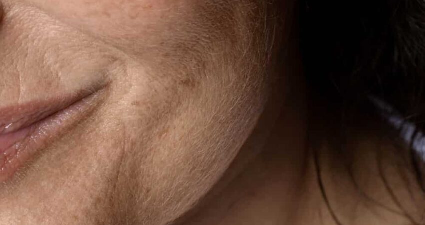 guia cicatrices acne