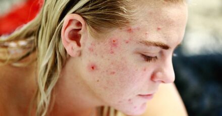 acne en adultos