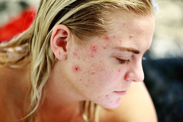 acne en adultos