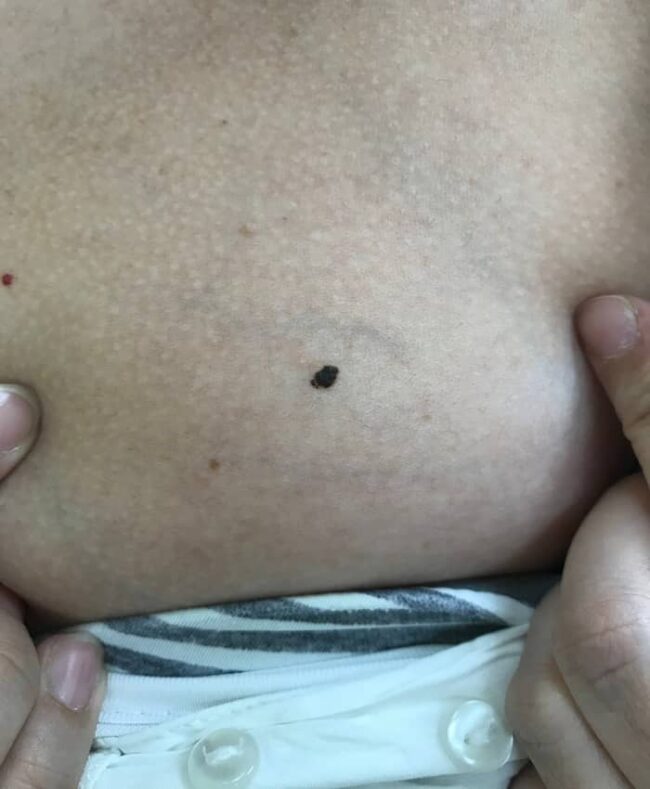 Nevus melanocítico puntiforme común (Benigno)