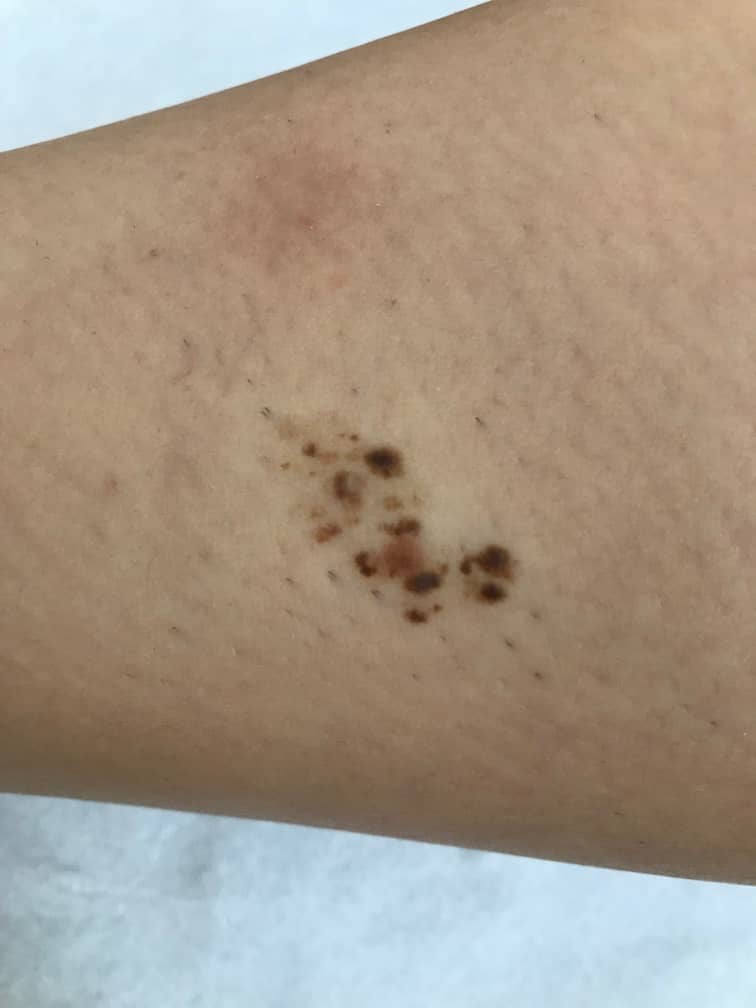 Tratamiento de eliminación de nevus y lunares en Leganés