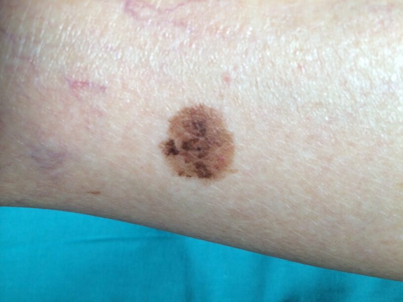 Nevus melanocito común (Benigno)