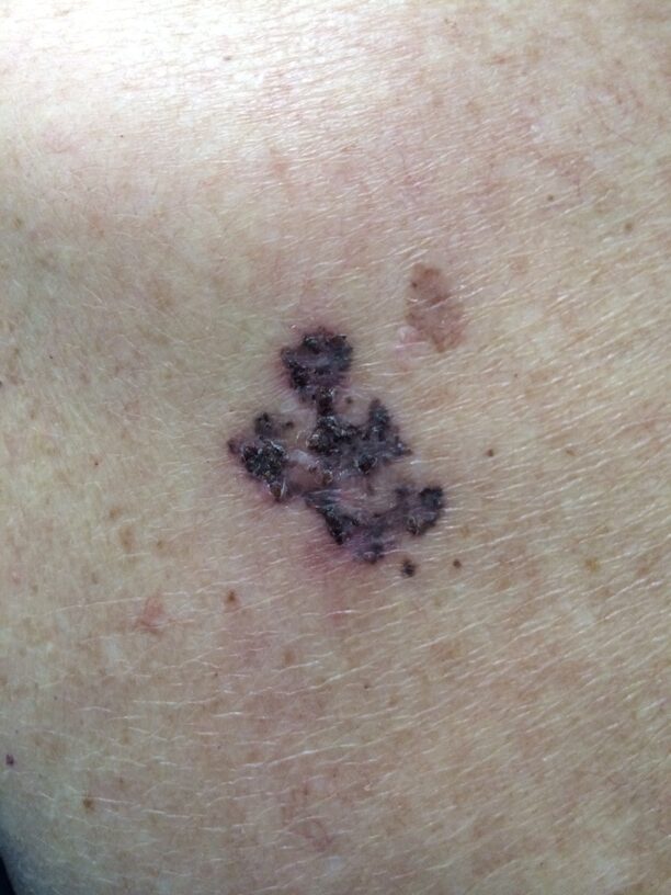 Examen y eliminación de nevus en clínica de dermatología en Leganés