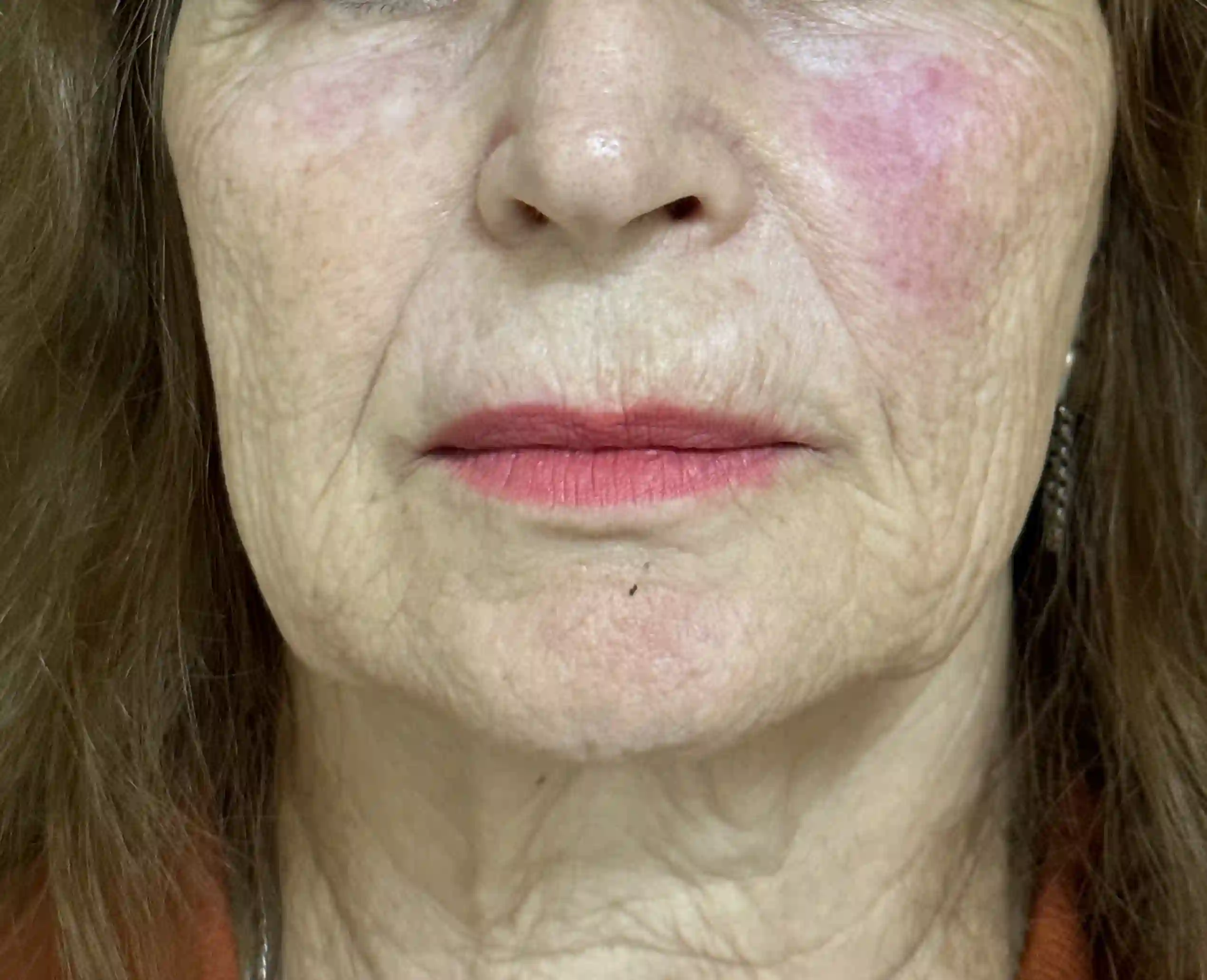 antes cirugia maxilofacial leganes