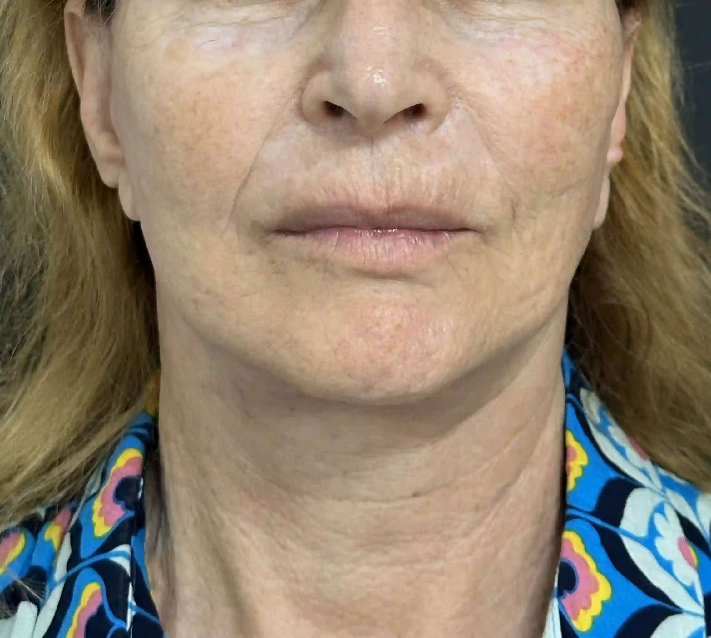 despues cirugia maxilofacial leganes