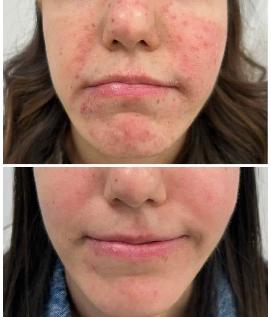 tratamiento rosacea