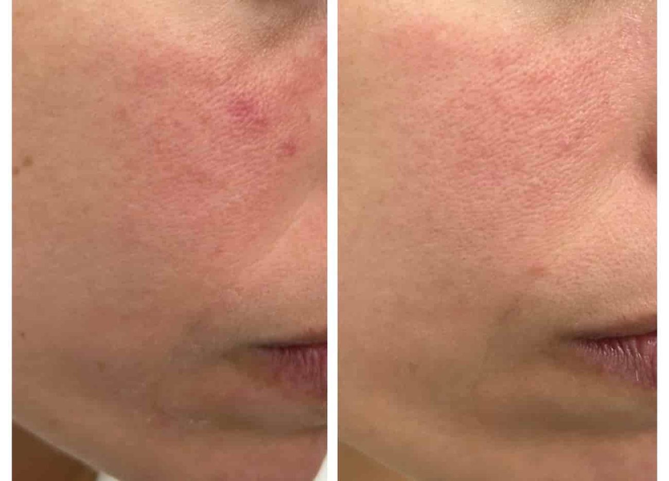 tratamiento rosacea leganes