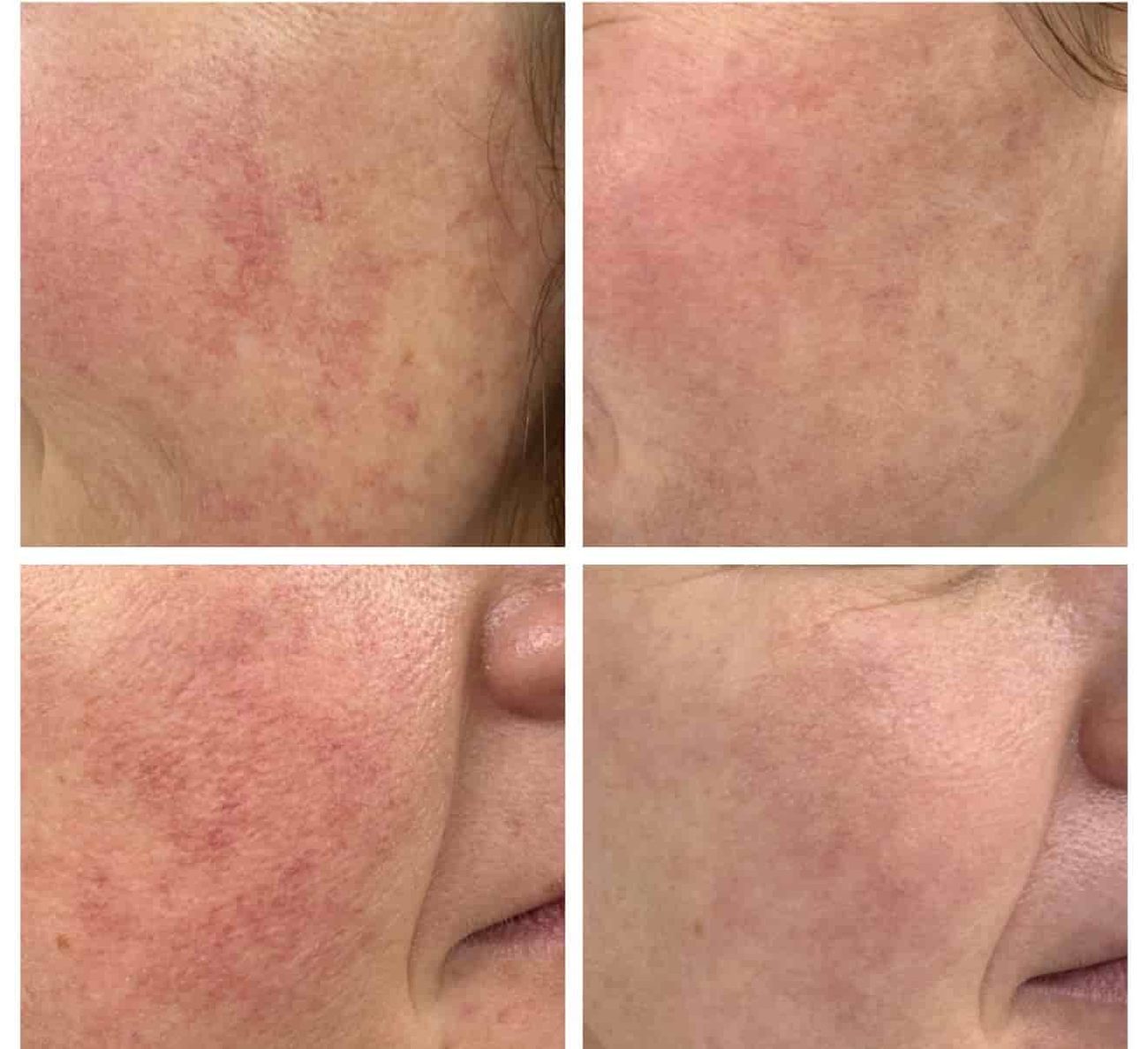 Evolución del componente vascular y reducción de telangiectasis faciales en Clínica Ceta